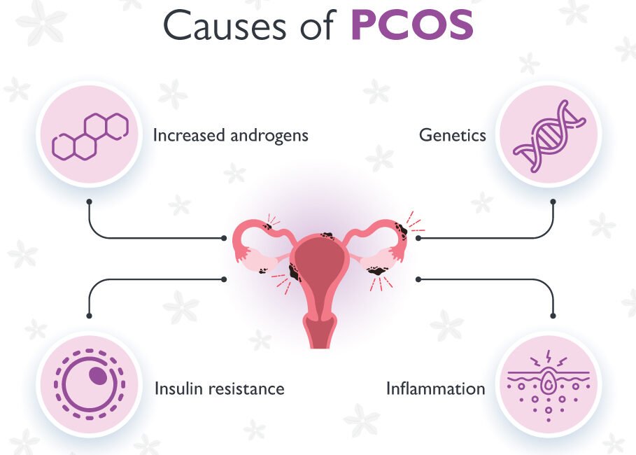 Causes_of_PCOS