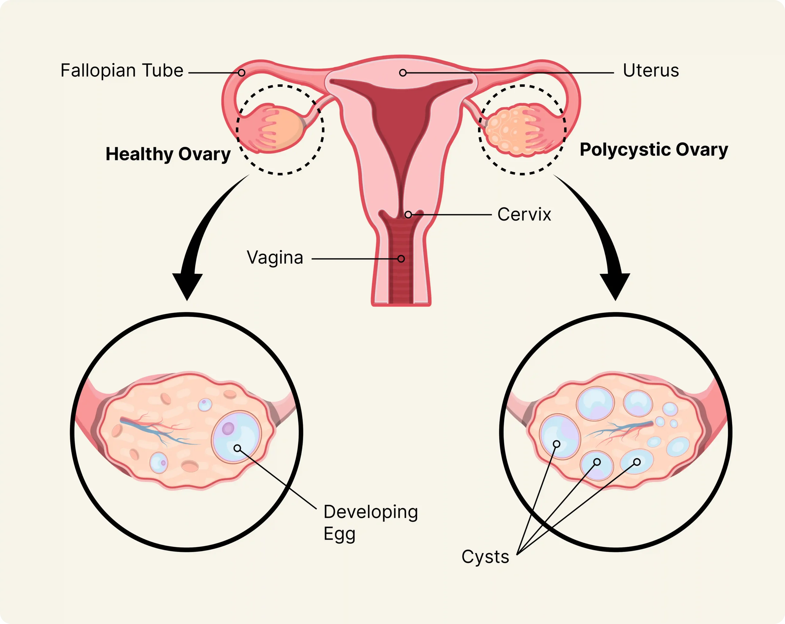 1708974637-pcos-1