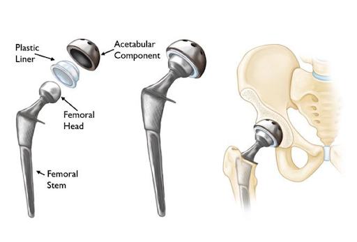 Bipolar Hip Replacement Surgery