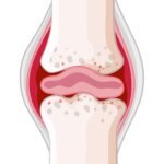 Moderate RA in Stage 2