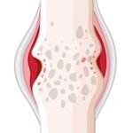 Stage 4 Final Stage of RA